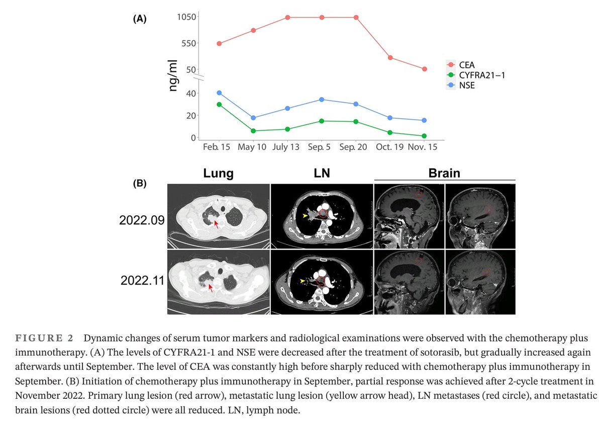 CrozrX's tweet image. Mixed response to the first-line treatment of KRAS G12C inhibitor, sotorasib, in 🫁 NSCLC: A brief report.
#Immunoenvironment 
#sequencing 
🔻
doi.org/10.1002/ccr3.8…