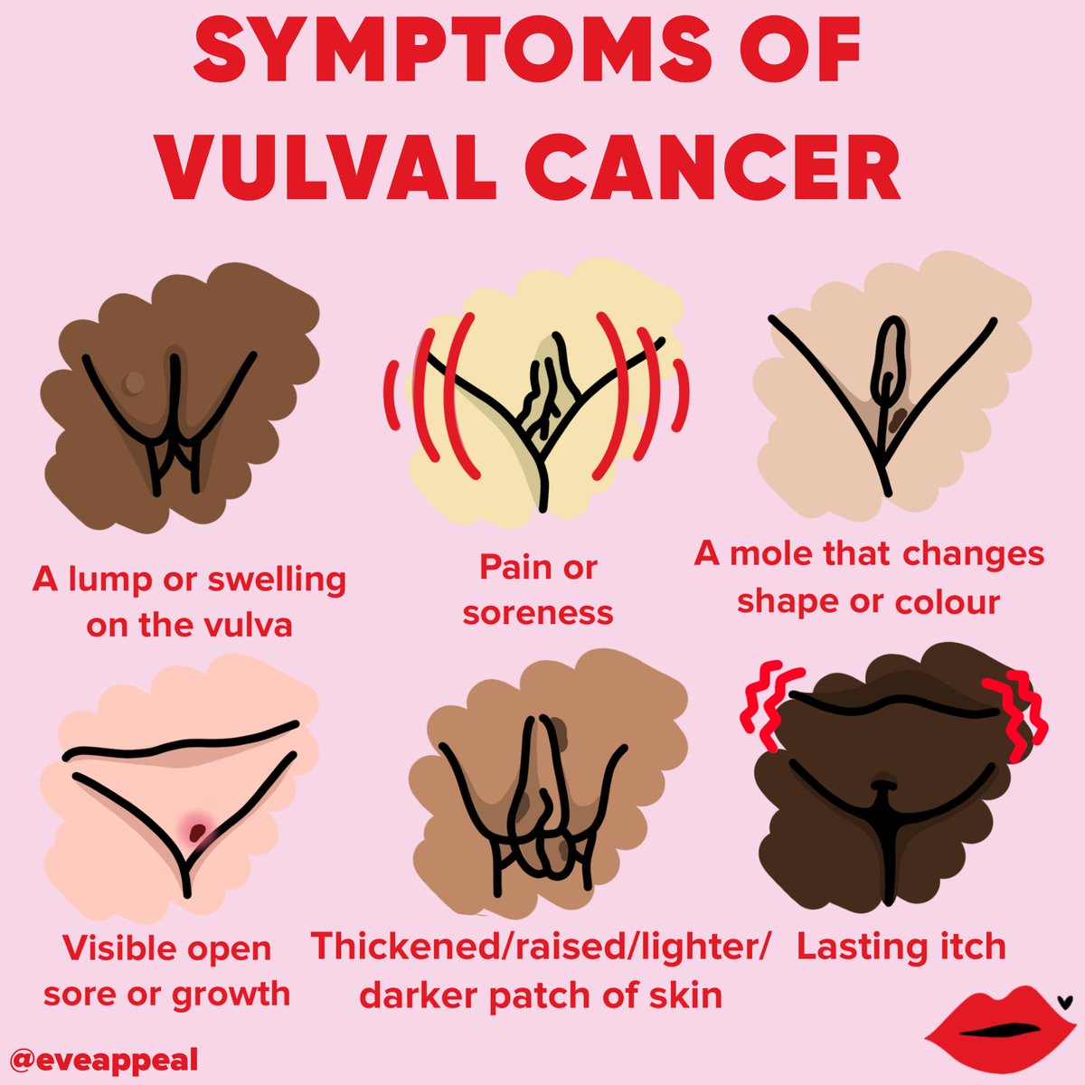 Another key group of symptoms to look out for is changes to the vulva. Vulval cancer affects around 1,400 women and people with vulvas a year in the UK. A thread🧵