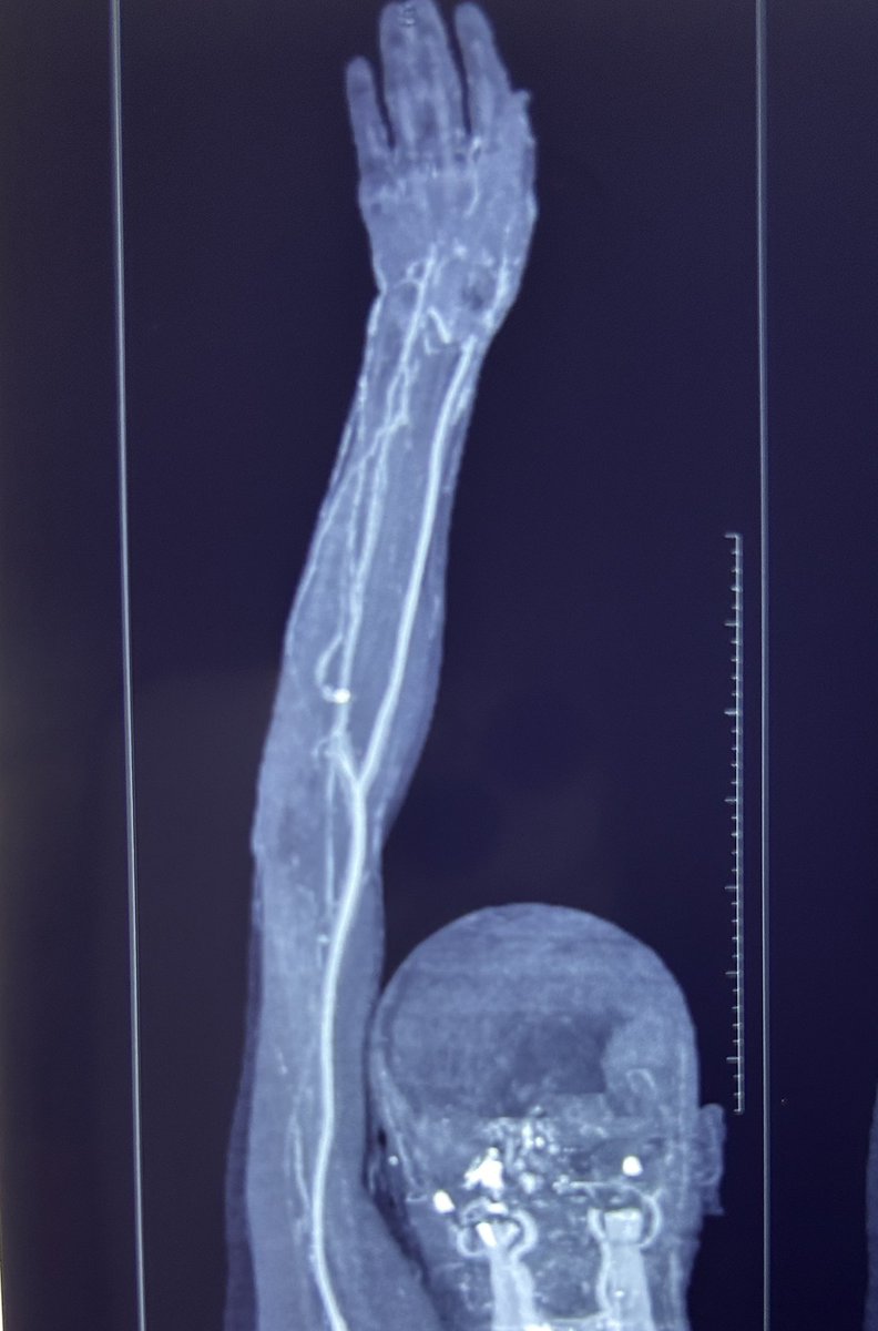 Young lady with severe pain in right UL , CT #angiography revealed poor flow in ulnar artery while clinically it was Radial artery #ischaemia also 

Successfully treated by removing clot from both Ulnar & Radial Artery , now on oral anti coagulation 

#thrombosis #WardRounds