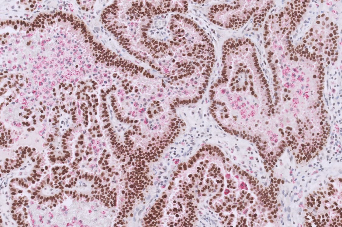 TTF-1/NapsinA dual stain. So pretty!  #pathx #pathtwitter #thoracicpath #pulmonarypath