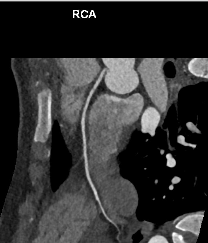 RCA off Left Main Coronary Artery