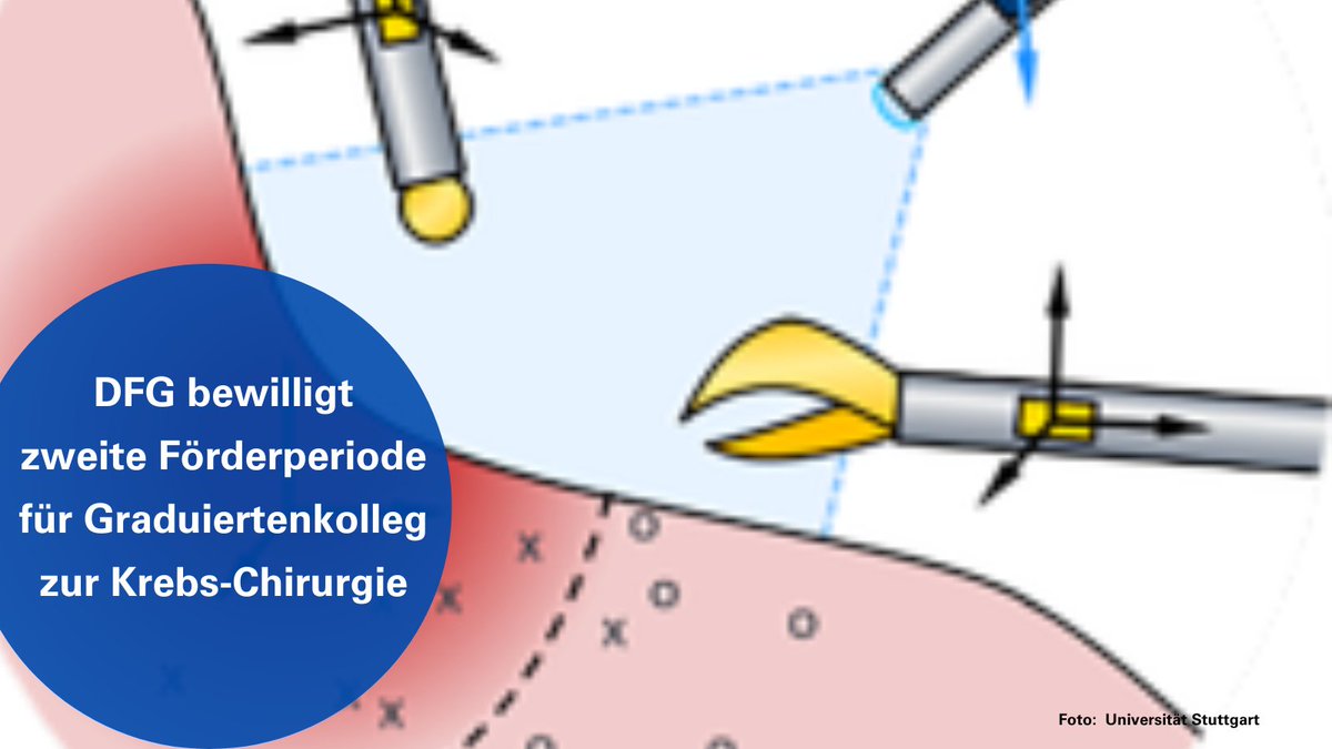 Die #UniStuttgart & @uni_tue forschen seit 2019 an innovativen #Sensorik-Methoden für #Krebs-OPs. Nach erfolgreicher Evaluierung durch die #DFG geht die Förderung für viereinhalb Jahre weiter! 🧬🔬  👉sohub.io/uq1c

#Onkologie #Krebsforschung #Medizintechnik