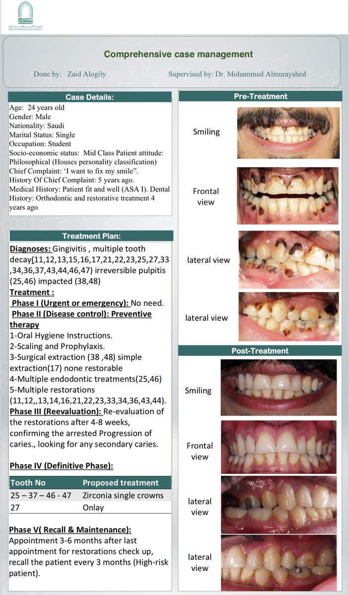 يوم ١٥/٥ كان يوم مميز انتهينا من مشوار طويل مع احد المراجعين و عرضت الحاله في يوم البحث العلمي بالجامعه شكرا لكل من قام معي وشكر خاص  للدكتور محمد المريشد و الدكتور احمد الجوهر  <a href="/18Amj/">Dr. Ahmed Mohammed Al-Johar</a>