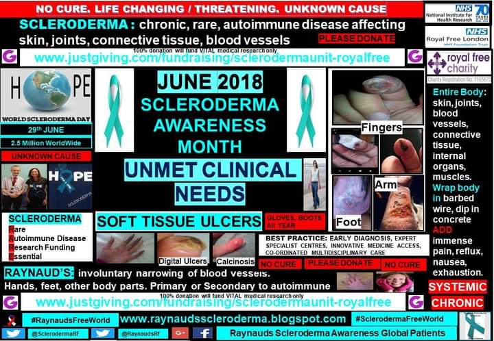 June #SclerodermaAwarenessMonth 
Flashback 2018 Unmet Clinical Need: Digital Ulcers 
blog.raynaudsscleroderma.co.uk/2018/05/soft-t…
Read more:  royalfreecharity.org/news/fundraisi…
Leave a gift in your Will : royalfreecharity.org/giftsinwills/
#SclerodermaFreeWorld #RaynaudsFreeWorld 
#Research #Scleroderma #SystemicSclerosis