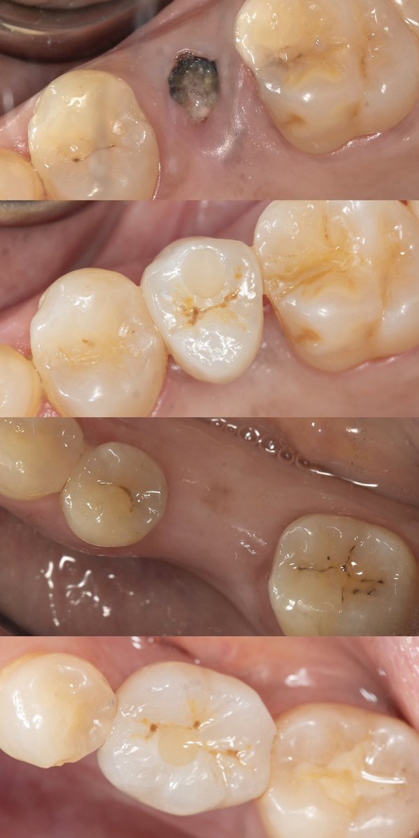 2 Screw-retained Implant crowns to replace #25,36.