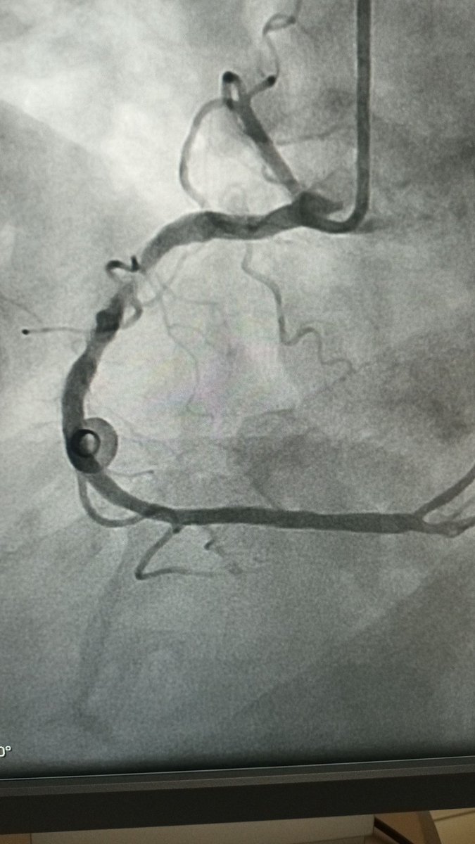 AlkashkariWail's tweet photo. 82y♂️ unstable angina. Heavily calcified RCA, barley hydrophilic wire passed. Rotablation 1.25, then 1.5 burr. Then HD IVUS-->4x30 Onyx Frontier. 
Congratulations to @AlHusayniF, our fellow for his first Rota case.
King Faisal Cardiac Center https://t.co/QPkZrPaw61