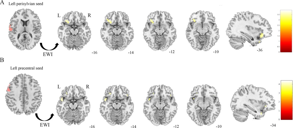 [Epilepsy] Talami et al.: 'This work advances our understanding of (a) interaction between centro-temporal spikes occurrence and vigilance fluctuations and (b) possible mechanisms responsible for language disruption in SeLECTS.' doi.org/10.1016/j.clin…