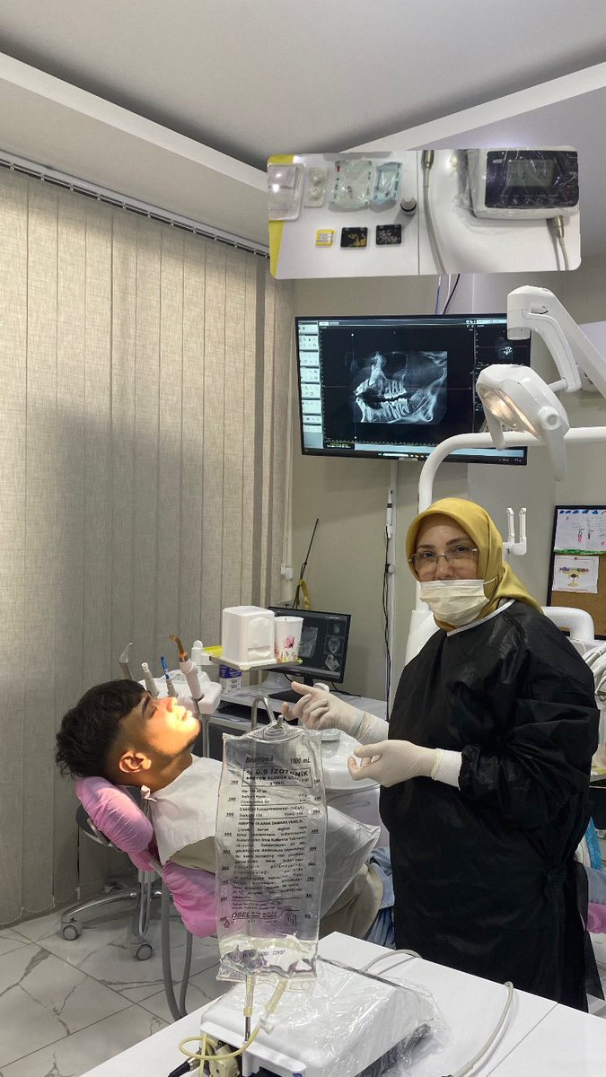 Hatay’dan gelen sevgili Abdulkadir’in damaktaki gönülü köpek dişin sürmesi için küçük bir operasyon planladık… Diş dizisine yerleşemeyen ve gömülü kalan dişler basit bir işlemle ağızda sürdürebilir.🙂 #iyileşiyoruz #ortodonti #teltedavisi #sinüslifting #kemikögmentasyonu