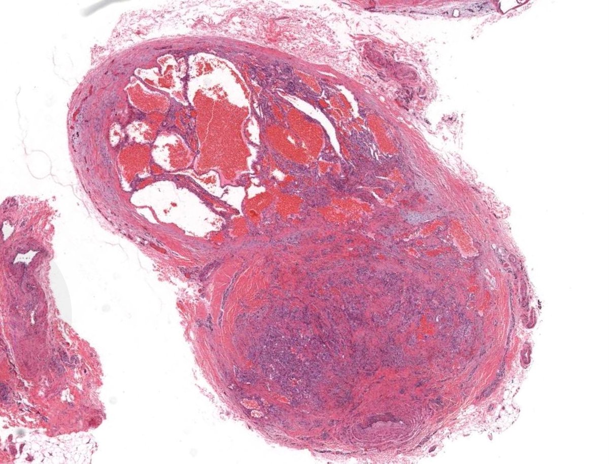 30 yo woman with a 'cyst' on the lower leg. Your diagnosis? 
Digital slide: kikoxp.com/posts/3074. 
Answer ✅ youtube.com/watch?v=O2tyoN… 
#pathology #pathologists #pathTwitter #dermpath #dermatology #dermatologia #dermtwitter #bstpath