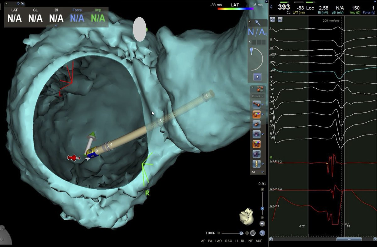 Chiara Valeriano (@chiaravaleriano) on Twitter photo Today’s PVC ablation with the PVC master <a href="/DrBerruezo/">DrAntonioBerruezo</a> : two morphologies, two spots, one zap⚡️each—PVCs gone! Loving the CT-guided approach more every day, especially for those tricky papillary muscle PVCs <a href="/AlmorJulio/">Julio Marti Almor</a> <a href="/JAldereteM/">José Alderete M</a> <a href="/Davidsotoiglesi/">David soto-iglesias</a> Today’s PVC ablation with the PVC master <a href="/DrBerruezo/">DrAntonioBerruezo</a> : two morphologies, two spots, one zap⚡️each—PVCs gone! Loving the CT-guided approach more every day, especially for those tricky papillary muscle PVCs <a href="/AlmorJulio/">Julio Marti Almor</a> <a href="/JAldereteM/">José Alderete M</a> <a href="/Davidsotoiglesi/">David soto-iglesias</a>