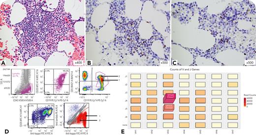 Biclonal mantle cell lymphoma ow.ly/ZaFz50RTHR4 #bloodwork #lymphoidneoplasia