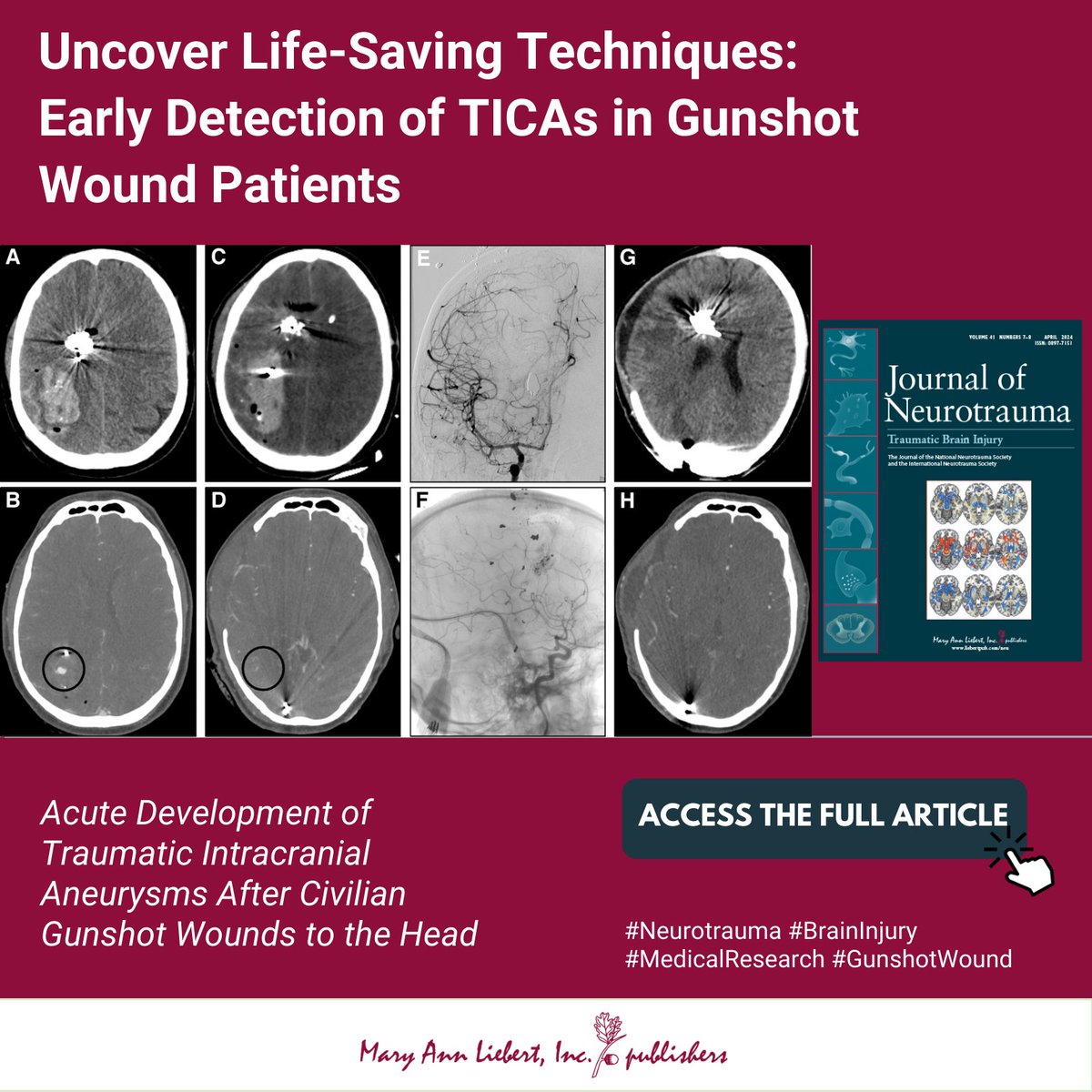 🧠 Traumatic intracranial aneurysms (TICAs) in civilian gunshot wounds to the head are often missed on initial scans. A @J_Neurotrauma study shows early CTA reveals TICAs are 10x more frequent and predict surgery. Learn more: ow.ly/1zui50RY2NZ #Neurotrauma #TBI #Research