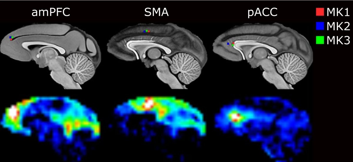 Marcus Kaiser (@connectomelab) on Twitter photo Dynamical and individualised approach of transcranial ultrasound neuromodulation effects in non‑human primates
Our last research with @jerome_sallet highlights the temporal dynamics of TUS on the brain in different targets and individuals.
doi.org/10.1038/s41598…
<a href="/UoNPIBeacon/">UoNPrecisionImaging</a> Dynamical and individualised approach of transcranial ultrasound neuromodulation effects in non‑human primates
Our last research with @jerome_sallet highlights the temporal dynamics of TUS on the brain in different targets and individuals.
doi.org/10.1038/s41598…
<a href="/UoNPIBeacon/">UoNPrecisionImaging</a>