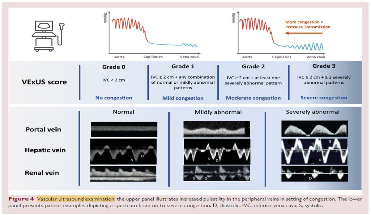 #NephX #MedEd #Medtwitter
USG en evaluación de Falla🫀FEVI preservada (HFpEF) 🧐

✔️Útil en evaluación inicial de imagen no invasiva. Algoritmo sospecha HFpEF👇🏼
✔️Mayor utilidad en evaluación de congestión☝🏼
🔸LUS 🫁
🔸FoCUS🫀
🔸VExUS 🫘

Dhont et al. European Heart Journal. 2024