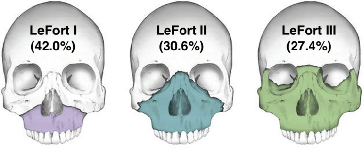 Le Fort Fracture - Management Protocol Le Fort fractures involve various levels of midfacial separation, classified into three main types based on the fracture pattern and severity. Le Fort I fractures represent a horizontal separation of the maxilla from the skull base,
