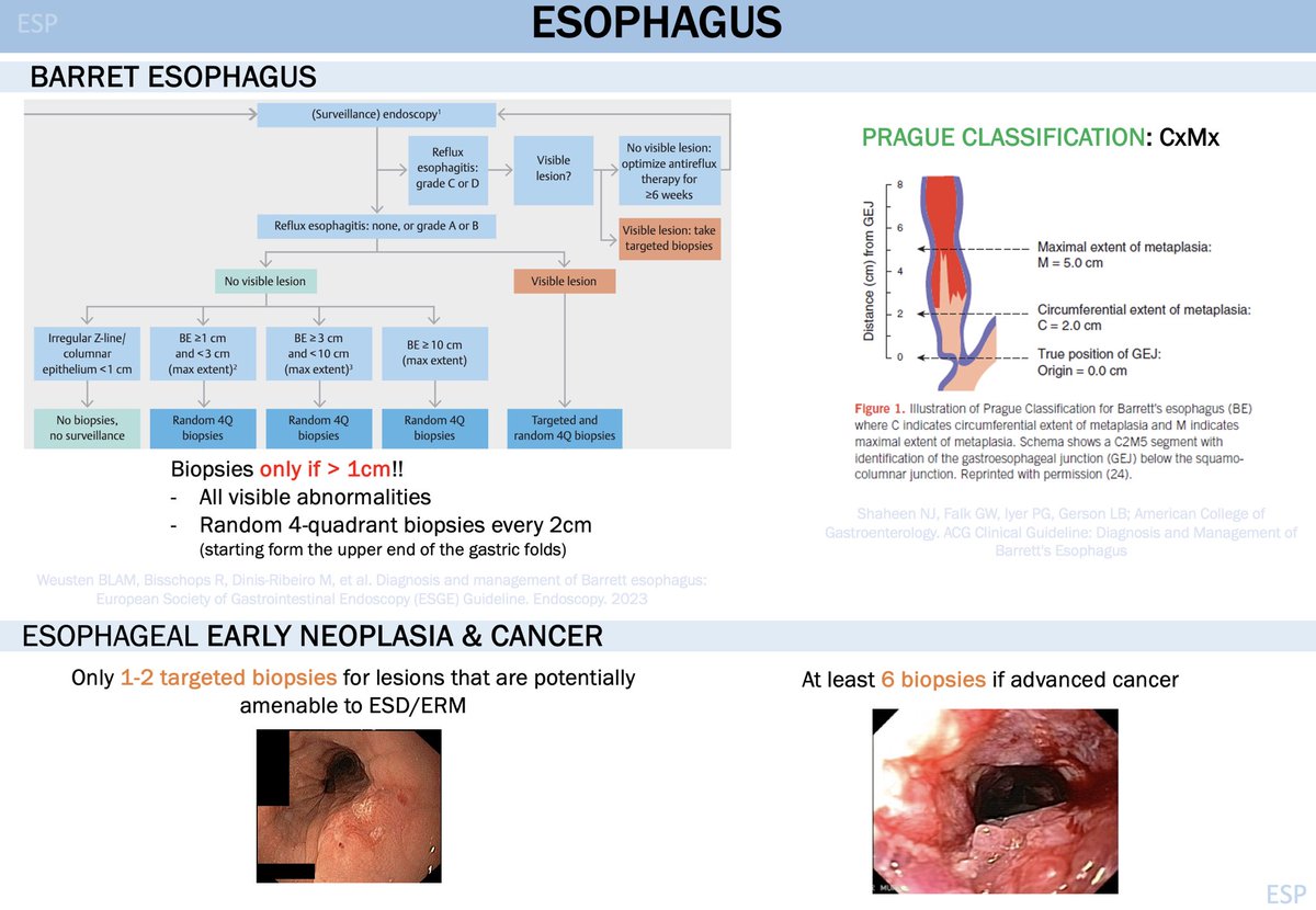 ElenaSantosP's tweet photo. Just reviewed 🔑 from multiple @ESGE_news  guidelines on #UpperEndoscopy 
➡️📍Specific protocols for each pathology❗️
✒️Multiple biopsies for advanced cancers vs. 1-2 targeted biopsies if EMR/ESD is possible 🍄 
Working with residents is always enriching🔝 #GIEndoscopy #GIFellows https://t.co/tXAkfnmLb1
