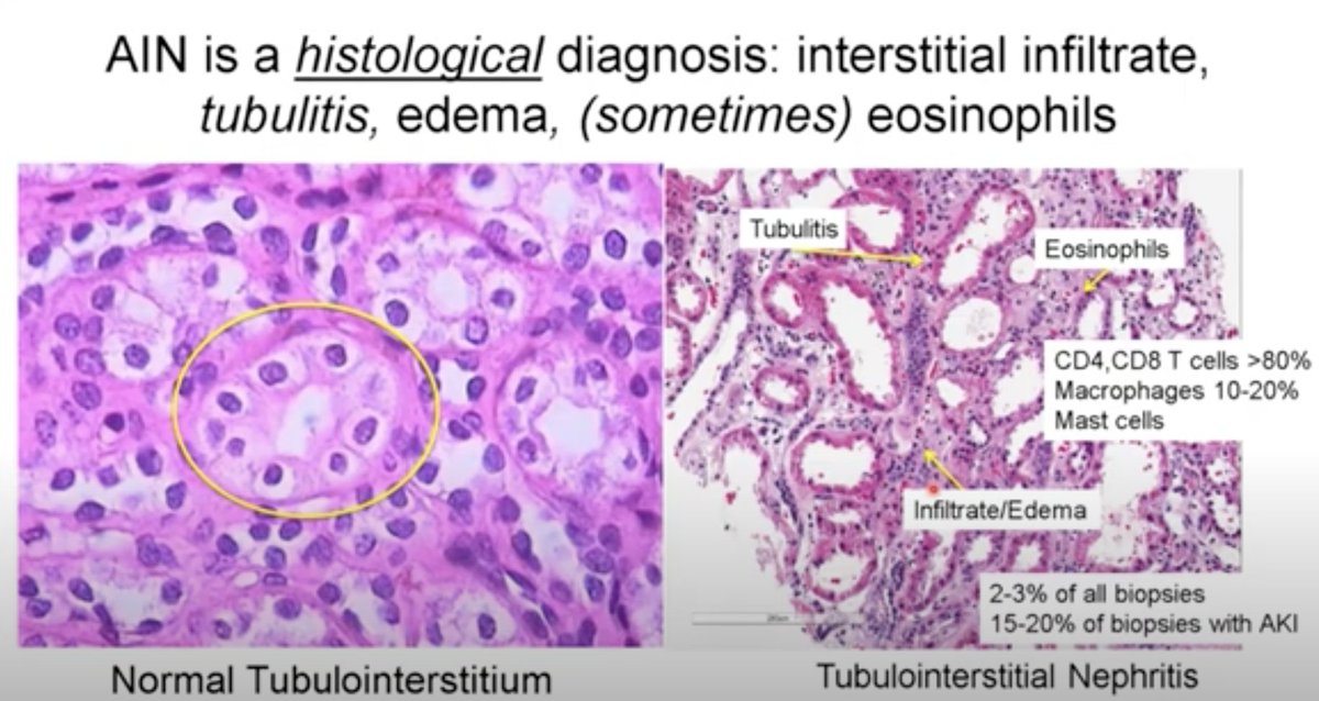 Dr. Dennis Moledina @dmoledina discusses his research into identifying and validating #biomarkers for the diagnosis of acute interstitial #nephritis. Watch his #GrandRounds talk now youtu.be/Bgk9c7VCZmc. #kidneycancer @SmilowCancer @YaleMed @YNHH