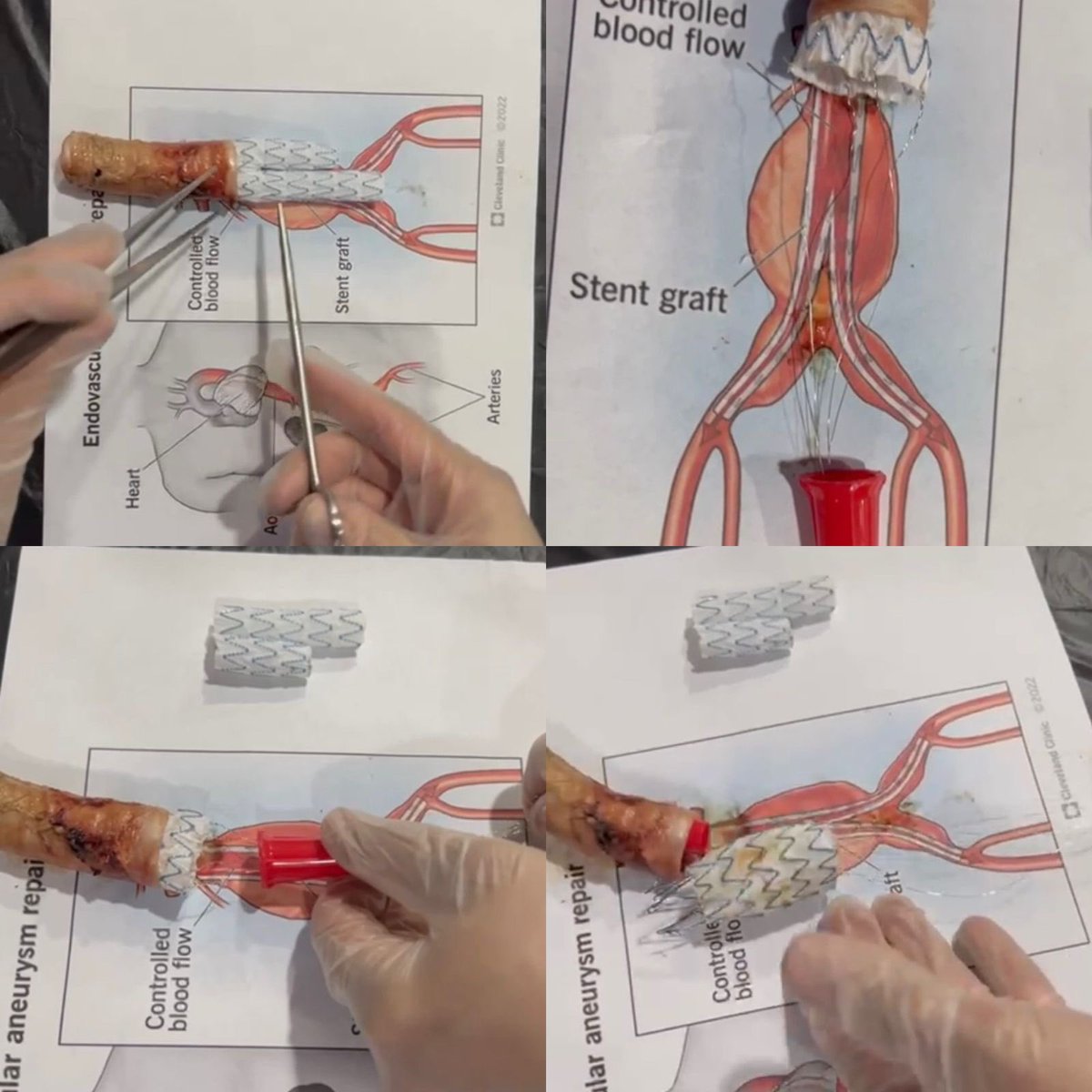 Hernando Thorne Velez, MD (@nandoenriquetv) on Twitter photo A New Device To Explant Aortic Endografts. An experimental study by our group led by <a href="/PipeCabreraV/">Dr Luis Felipe Cabrera Vargas MD FACS MACC MACCVA</a>
revistacirugia.org/index.php/ciru…
#SoMe4Surgery #AortaEd
<a href="/XavierBerardMD/">Xavier Berard</a> <a href="/farkomd/">frank arko</a> <a href="/VasculonR/">Ricardo Bernardo da Silva</a> <a href="/AWBeckMD/">Adam W. Beck</a> <a href="/GustavoOderich/">Gustavo Oderich</a> <a href="/ch_timaran/">Carlos Timaran</a> <a href="/drbermendes/">Bernardo Mendes</a> <a href="/PauloOcke/">Vascular Clinic Ocke Reis</a> @EfrenCantillo <a href="/cfbechara/">cfbechara</a> A New Device To Explant Aortic Endografts. An experimental study by our group led by <a href="/PipeCabreraV/">Dr Luis Felipe Cabrera Vargas MD FACS MACC MACCVA</a>
revistacirugia.org/index.php/ciru…
#SoMe4Surgery #AortaEd
<a href="/XavierBerardMD/">Xavier Berard</a> <a href="/farkomd/">frank arko</a> <a href="/VasculonR/">Ricardo Bernardo da Silva</a> <a href="/AWBeckMD/">Adam W. Beck</a> <a href="/GustavoOderich/">Gustavo Oderich</a> <a href="/ch_timaran/">Carlos Timaran</a> <a href="/drbermendes/">Bernardo Mendes</a> <a href="/PauloOcke/">Vascular Clinic Ocke Reis</a> @EfrenCantillo <a href="/cfbechara/">cfbechara</a>