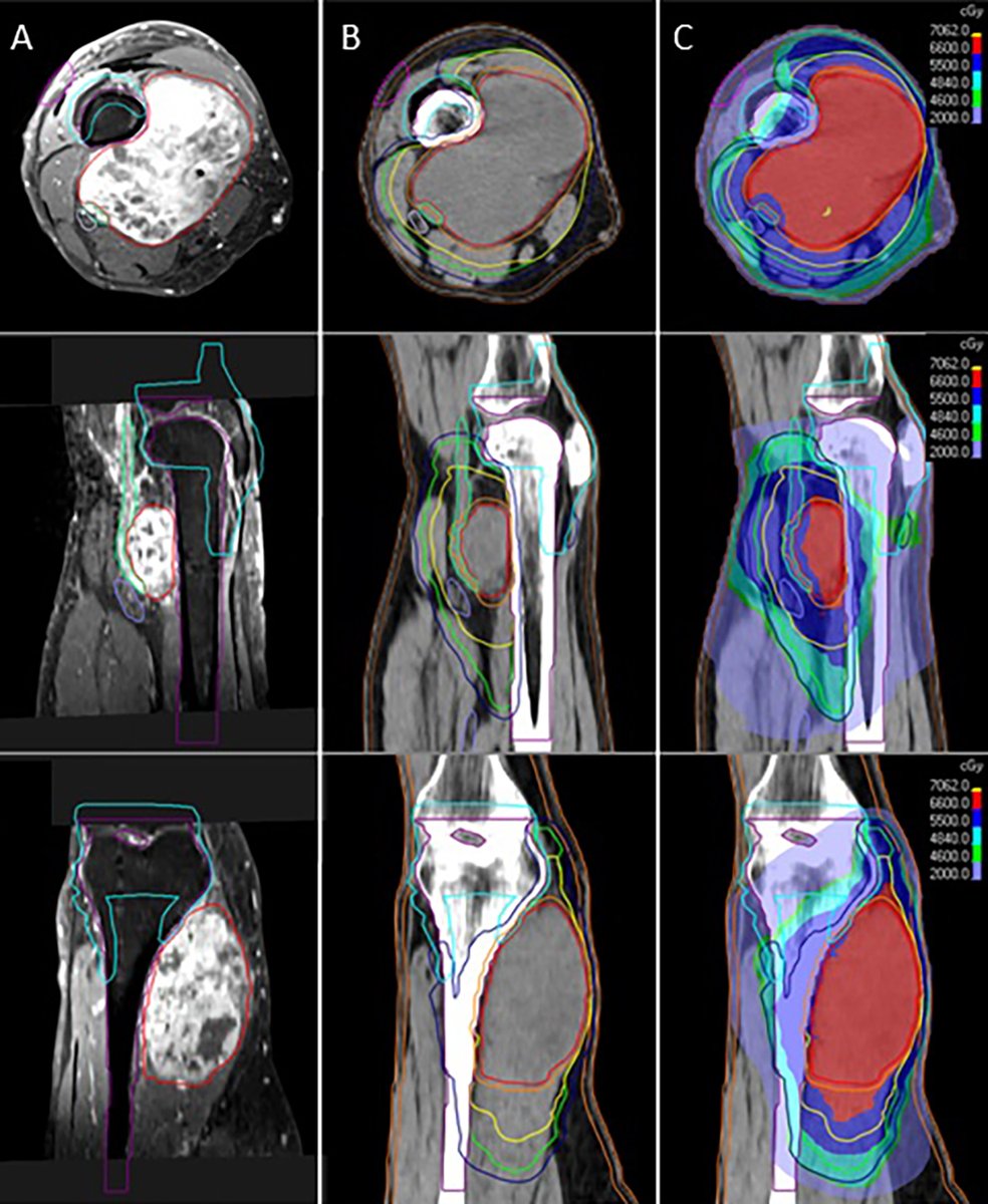 Getting Personal: Optimizing RT Dosing Strategies for Improved Outcomes

Read more ➡️ bit.ly/48wN3UC
#RadOnc #RadOncEd #RadiationTherapy #CancerTreatment