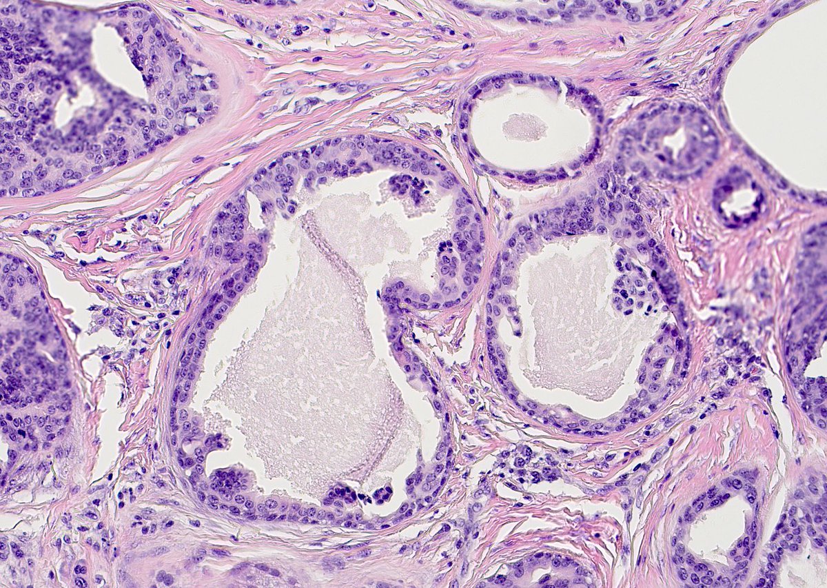Classic example of a rare #dermpath entity. What is this? 
Answer ✅ youtube.com/watch?v=iY11bS… 
#pathology #pathologists #pathTwitter #dermatology #dermatologia #dermtwitter