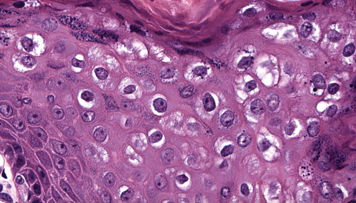 Scrotal lesion. Diagnosis?
Digital slide 🔬 kikoxp.com/posts/17372
Answer ✅ youtube.com/watch?v=_pFCng… 
See also: kikoxp.com/posts/7976 & kikoxp.com/posts/6126
#pathology #pathTwitter #dermpath #dermatology #dermatologia #dermtwitter