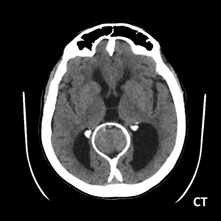 #AJNRcc >> May 27, 2024 >> What is the diagnosis for this 63-year-old previously healthy woman presents to the emergency department after experiencing a transient loss of consciousness? Submit your answer at ow.ly/70nc50RYSW8.