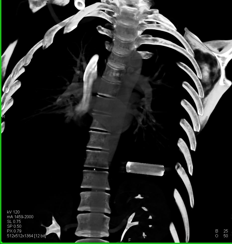 Can you guess what object this patient swallowed?
