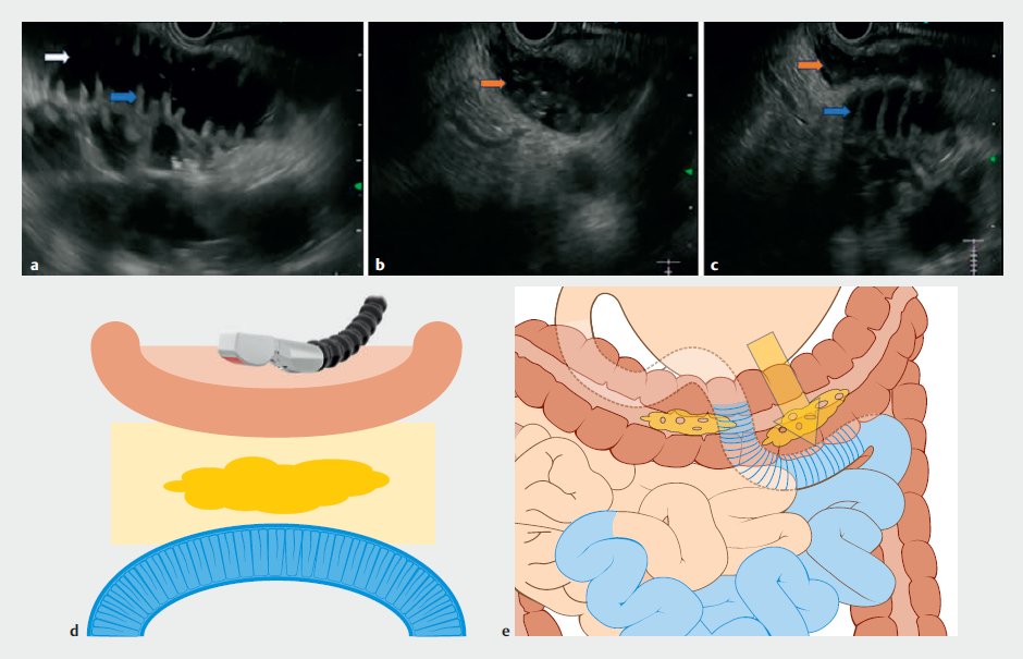E-Video: Endoscopic ultrasound  gastroenterostomy: how to avoid inadvertent gastrocolostomy

by Jimil Shah et al.

Find the full text and video here: doi.org/10.1055/a-2234…