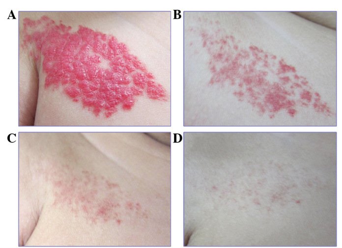 💊 TIMOLOL is a type of drug called a beta-blocker. It comes as a GEL called  maleate 0.5%, that is spread onto the HAEMANGIOMA. 

📍It helps to STOP haemangiomas (birth mark) from growing and can speed up the NORMAL SHRINKING process.

#MedEd #MedX #MedTwitter #CardioEd