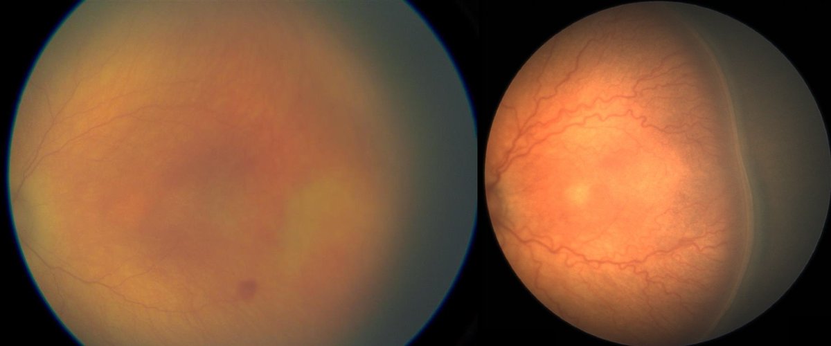 Retinopathy of Prematurity 
Left: 1 week post antivegf
Right: 10 weeks post antivegf

These pics of the same eye were taken on diff cameras with diff aspect ratios, illumination, degrees, and colour.

Despite those differences, can you recognise the Treatment-warranted ROP here?