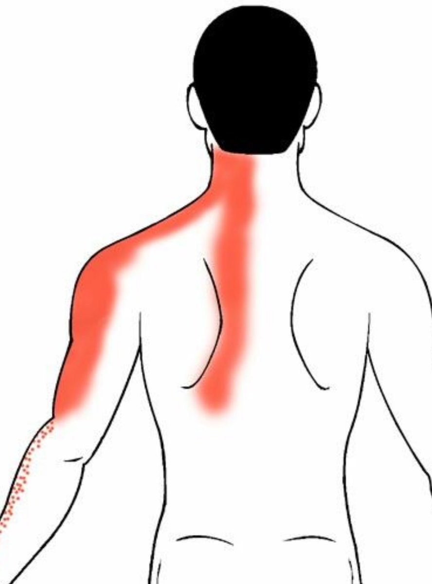 الالم في المنطقة الحمرا ء اللي في الرقبة والكتف ويمتد قليلا للظهر ، غالبا تكون نقاط Trigger Point عقد عصبيه تسبب الم عام في الظهر والرقبة وعند الضغط عليها تكون مؤلمة، جلسة ال Healing Trigger تساعد في اختفاء هده النقاط تدريجيا مع التدرج في تخفيف الالم للحجز ت/ 66634919 <a href="/salrashed/">صلاح صالح الراشد</a>