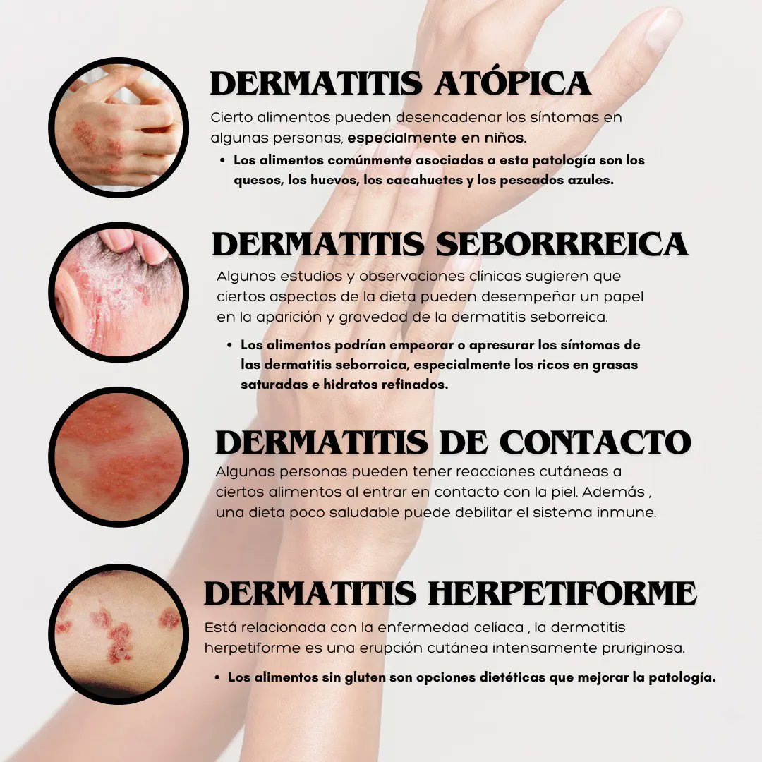 ¿Sabes qué tipos de dermatitis se ven afectados por la alimentación 🥗 ?