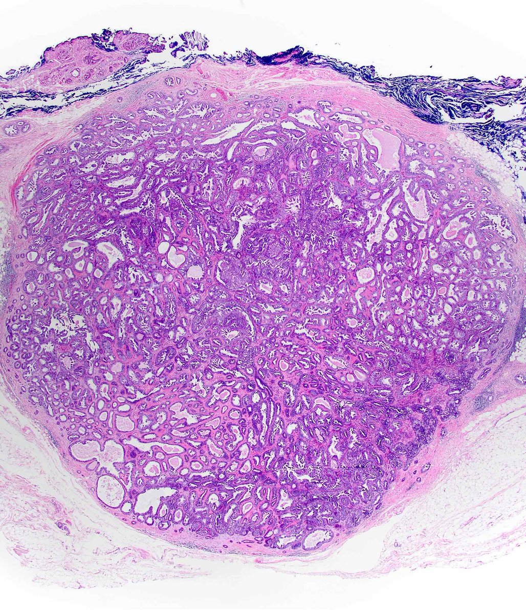 Pathoutlines's tweet photo. Image Quiz! A 65 year old woman had a right breast lumpectomy showing a well circumscribed firm nodule with a lobulated and granular cut surface. Histologic features are shown in the image. What is the diagnosis? (Continued)
#PathTwitter #ImageQuiz #PathologyOutlines #Diagnosis https://t.co/Yr7yVgJkt5