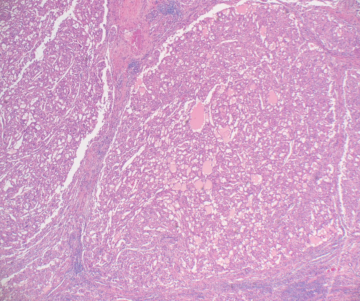 slusagar's tweet image. #GUpath nephrectomy:

cribriform/sieve-like pattern FH-deficient RCC

✔️although papillary growth is most commonly👀, others include solid, crib/sievelike, sarcomatoid, tubular, cystic, low grade oncocytic
