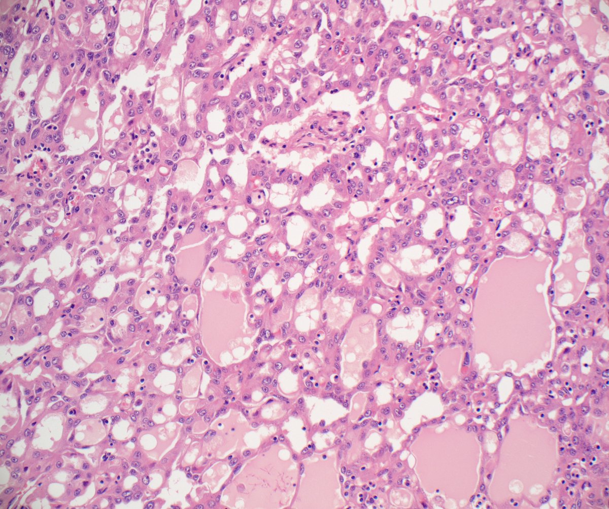 slusagar's tweet image. #GUpath nephrectomy:

cribriform/sieve-like pattern FH-deficient RCC

✔️although papillary growth is most commonly👀, others include solid, crib/sievelike, sarcomatoid, tubular, cystic, low grade oncocytic