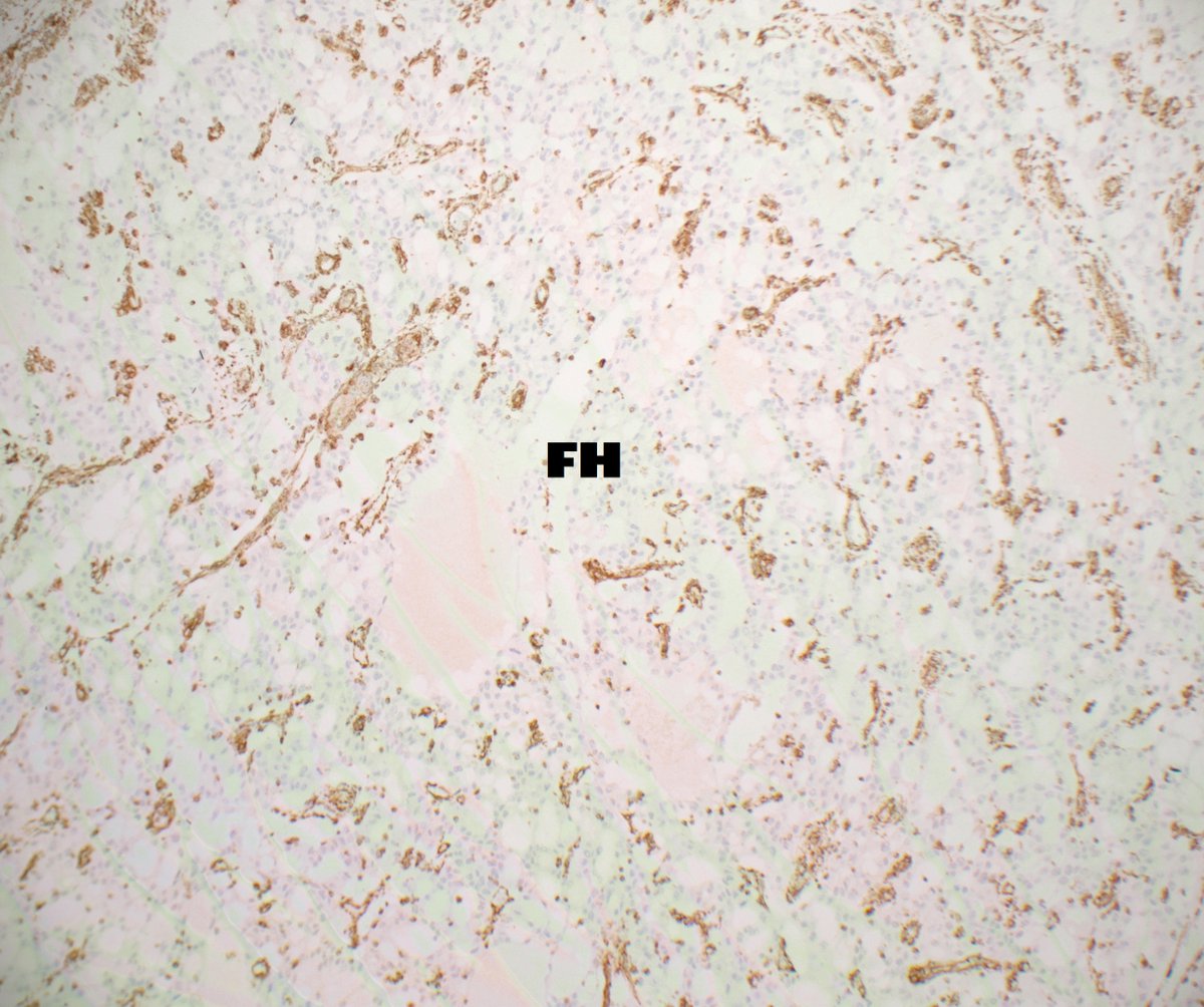 #GUpath nephrectomy:

cribriform/sieve-like pattern FH-deficient RCC

✔️although papillary growth is most commonly👀, others include solid, crib/sievelike, sarcomatoid, tubular, cystic, low grade oncocytic