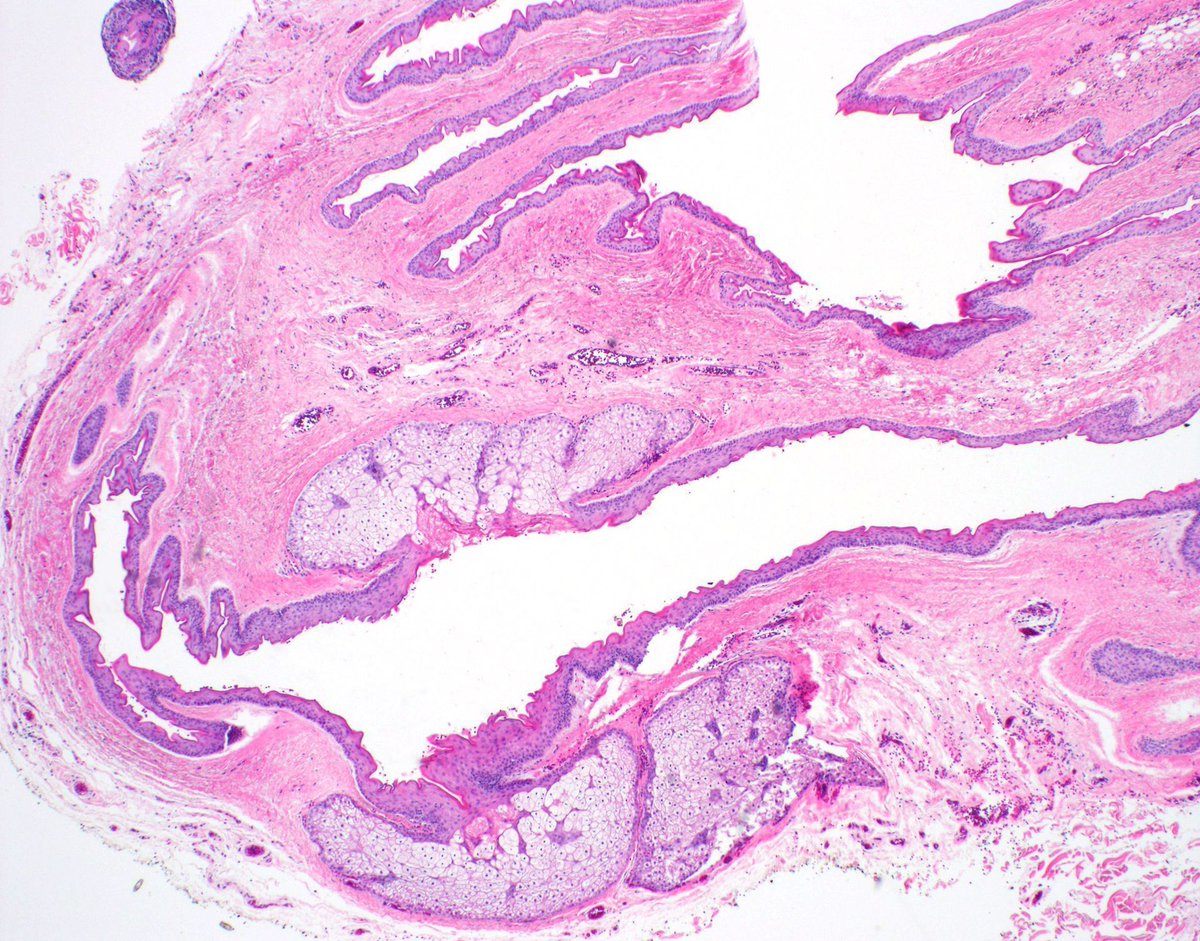 Adult with a cyst on the chest. Can you make the diagnosis from one pic? 
Answer: youtube.com/watch?v=NPaZrL… 
#pathology #pathologists #pathTwitter #dermpath #dermatology #dermatologia #dermtwitter