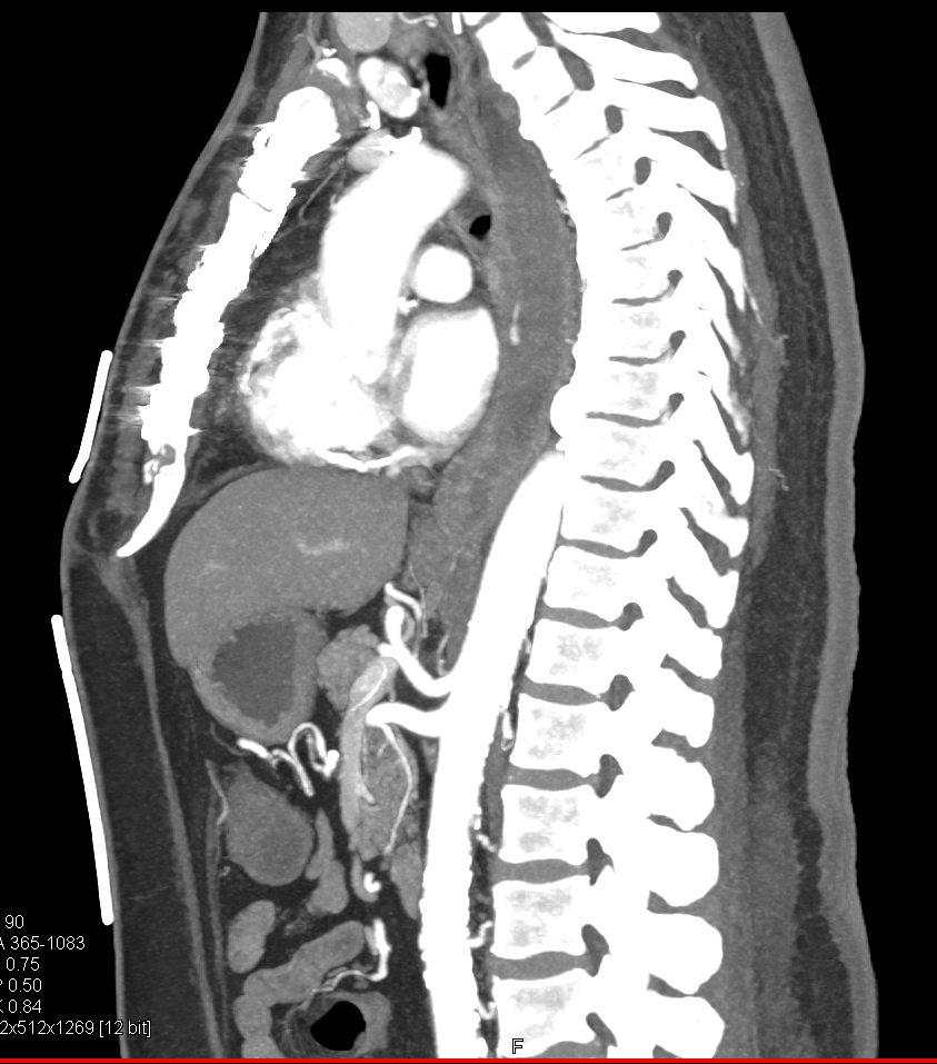 Esophageal Bleed from Ulcer