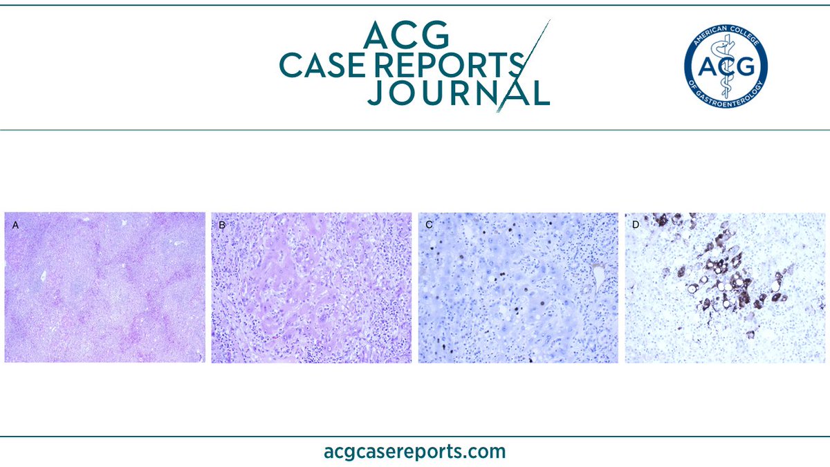 ACG Case Reports Journal Case of the Month:

Upadacitinib-Induced Hepatitis B Reactivation Leading to Liver Transplant
Sarosh Ahmed Khan, MD; Rida Zahid, MBBS & Muhammad Amir, MD
🔎 bit.ly/4dRGKPn

@KhushbooSGala @VibhuC_MD