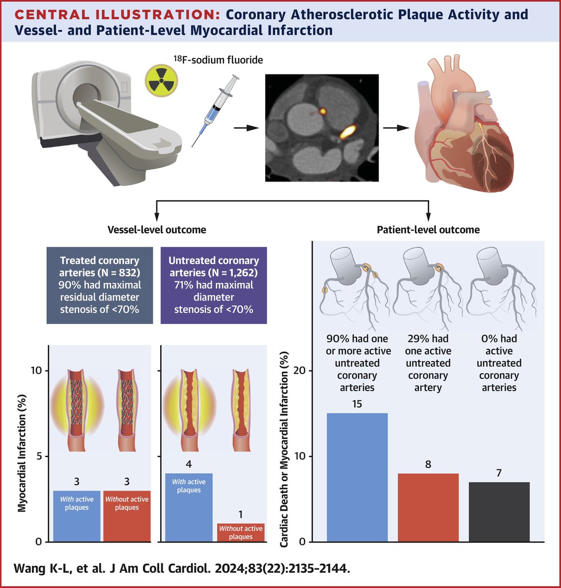 Secondary analysis of the PRE18FFIR study showed individual coronary atherosclerotic plaque activity is associated with subsequent myocardial infarction in the same coronary artery territory, which cascades into patient-level risk bit.ly/45fT9Jf #JACC #cvMI #cvPET