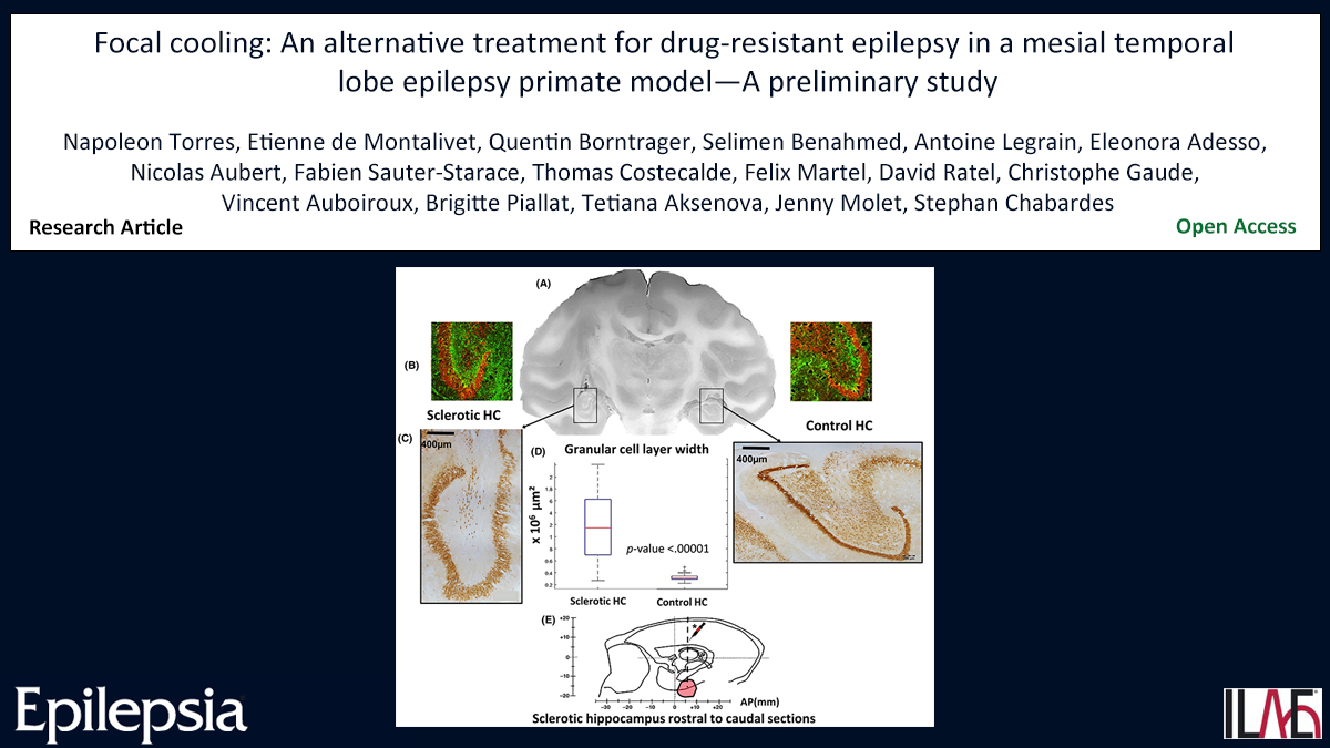 Key point: Seizure detection was improved by monitoring focal temperature changes in the epileptogenic zone (sclerotic hippocampus) during #seizures. doi.org/10.1111/epi.18… #epilepsy #implantabledevice #neuromodulation #sensors #Ilae @IlaeWeb @epilepsiajourn @WileyNeuro