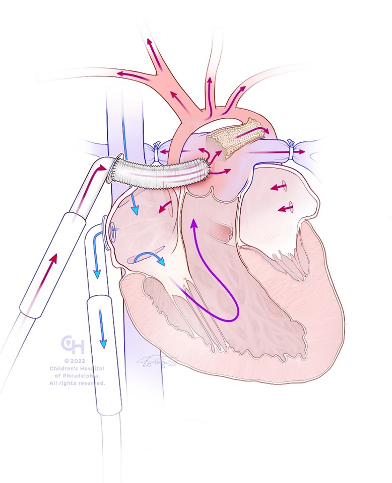 AATS (@aatshq) on Twitter photo Researchers from the <a href="/ChildrensPhila/">Children's Hospital</a> found that off-pump single ventricle VAD placement is technically feasible and can be done at the time of hybrid stage 1 palliation with minimal operative morbidity as a bridge to transplant. Read in #JTCVS: doi.org/10.1016/j.xjtc… Researchers from the <a href="/ChildrensPhila/">Children's Hospital</a> found that off-pump single ventricle VAD placement is technically feasible and can be done at the time of hybrid stage 1 palliation with minimal operative morbidity as a bridge to transplant. Read in #JTCVS: doi.org/10.1016/j.xjtc…