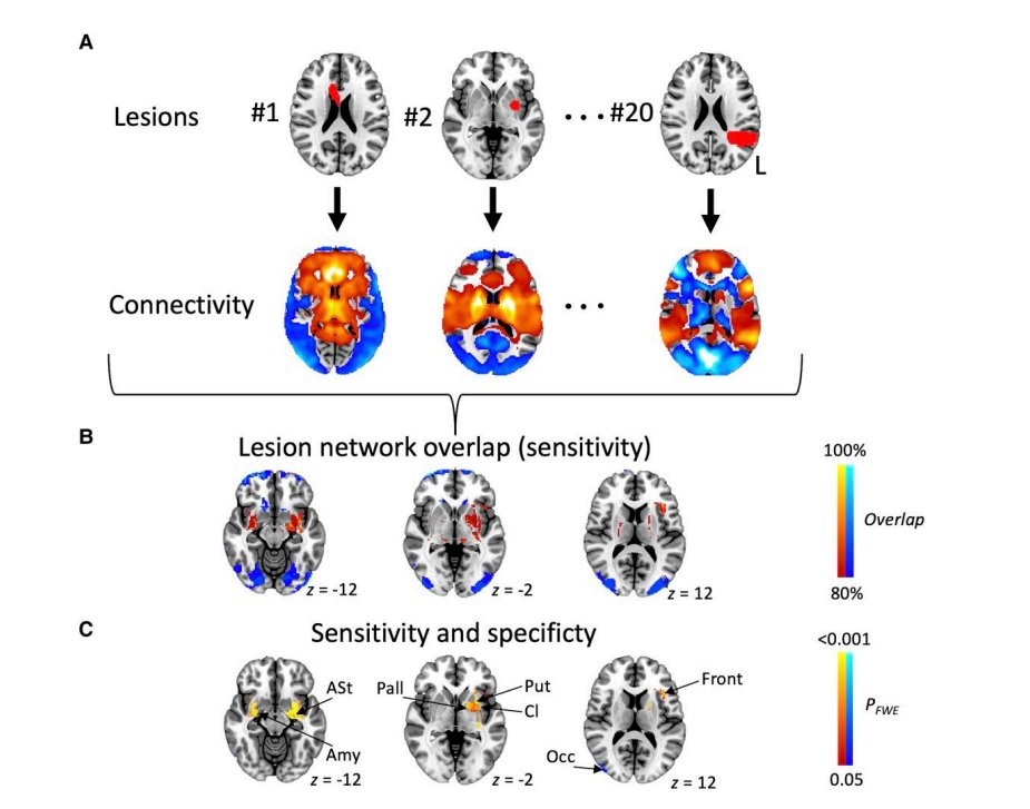 Localization of stuttering based on causal brain lesions academic.oup.com/brain/advance-…