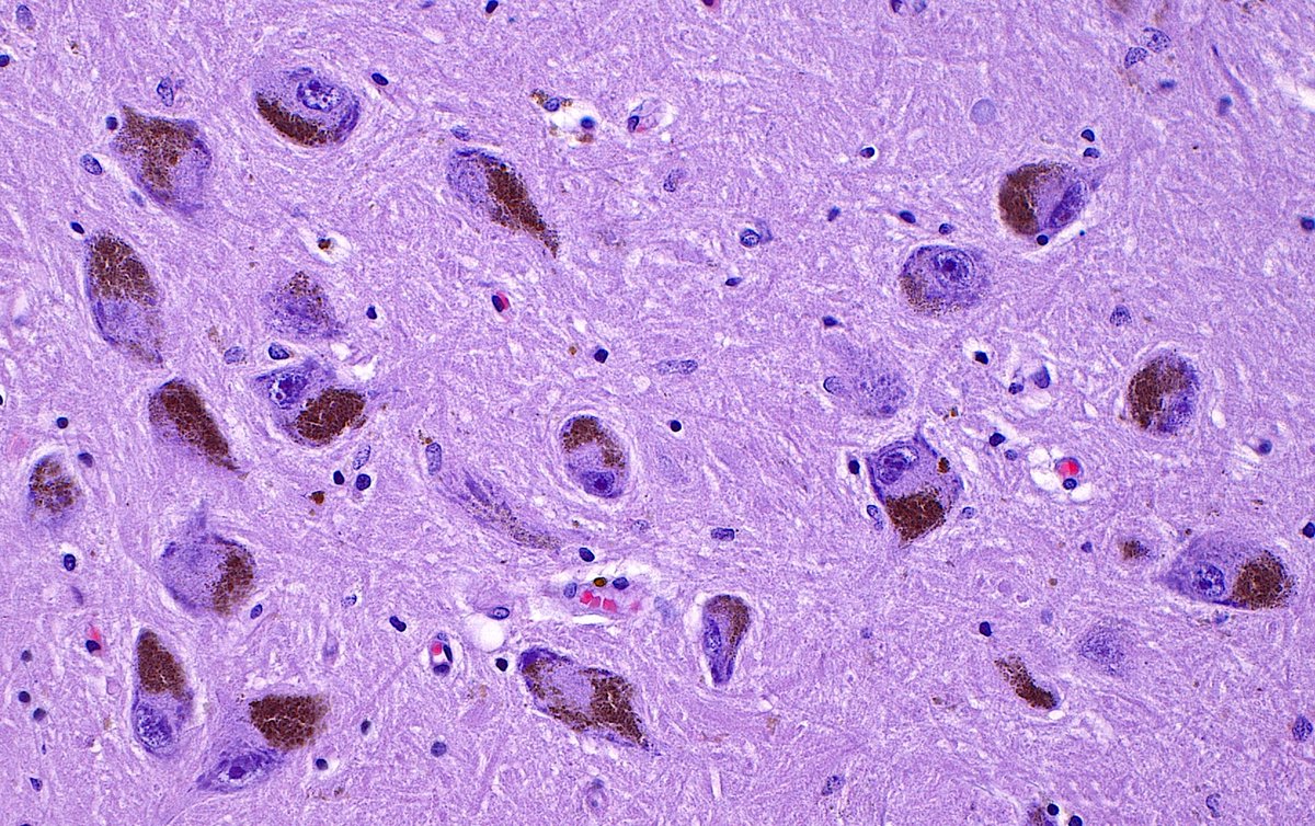 Pigmented neurons of the substantia nigra ~ 🧠🔬 #neuropath #neurology #histology #pathology