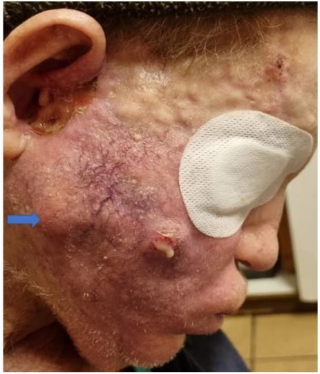 Growing, oozing masses begin growing on a man’s face post mRNA vaccine. This is his current condition 13 months after taking the Pfizer Vaccination. His symptoms began 4 days after the first dose.