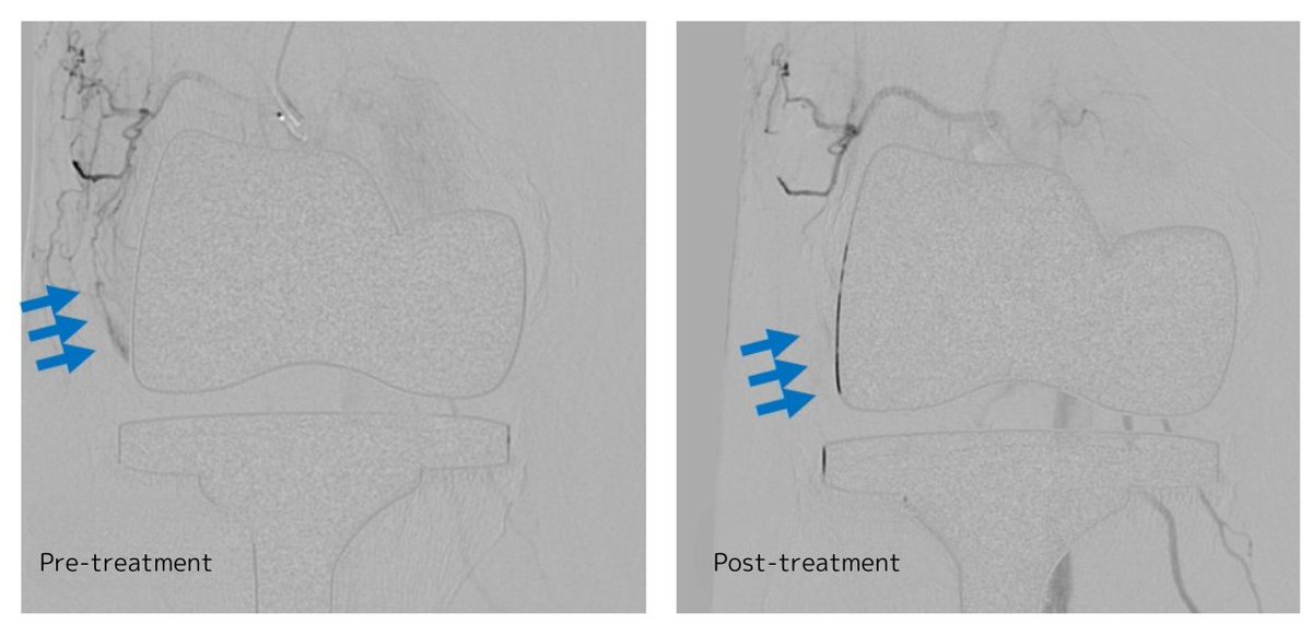 We found unnecessary blood vessels causing the bleeding. After catheter treatment to reduce these vessels, there's been no recurrence for a year.

#CatheterTreatment #KneePain #RecurrentHemarthrosis #Embolization