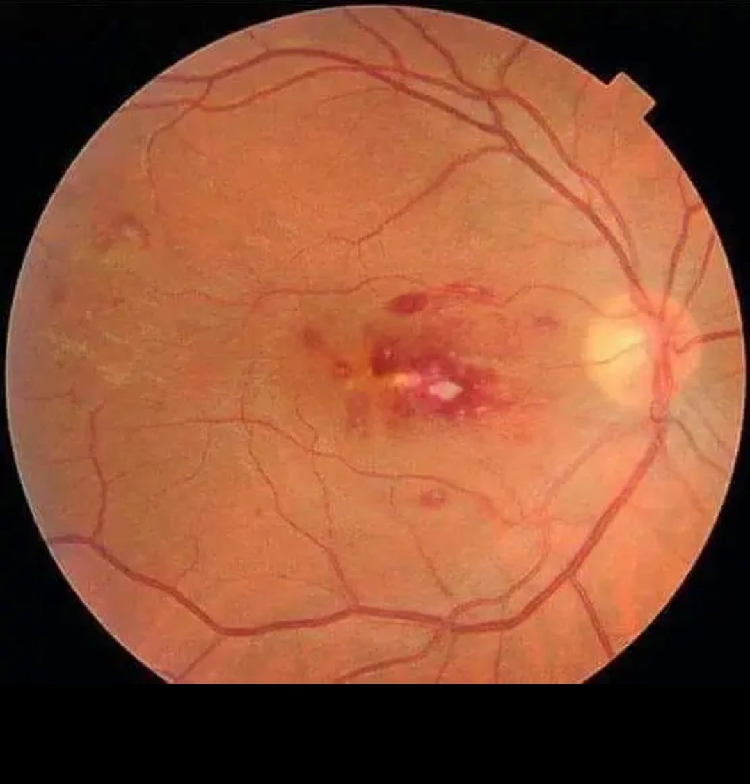 The red spots with clear centres r the retinal haemorrhages... #ROTHS_SPOTS 
Classical sign of #IE.  Mentioned in the options... 
Ddx : post treatment in multiple myeloma,  leukaemia....
#MedEd 
#MEDHM 
#MedX 
@IhabFathiSulima