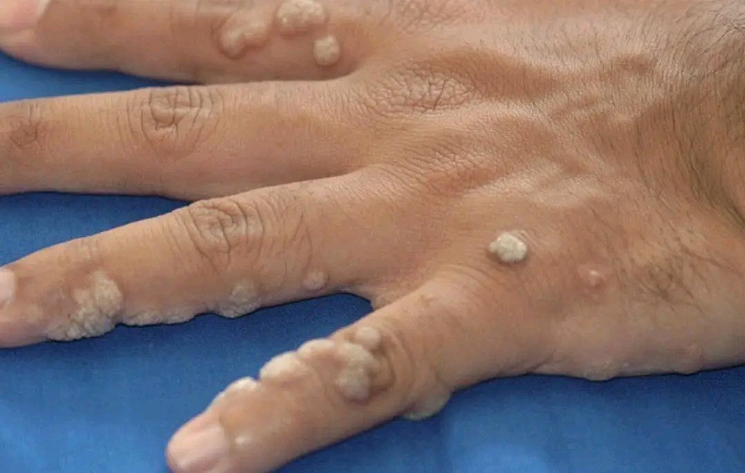 Patient presents because of these lesions in the hand.
 What is your diagnosis?
#MedEd 
#MEDHM 
#MedX 
@IhabFathiSulima