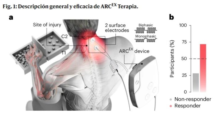 #Estimulacióneléctrica no invasiva de la médula espinal en la #tetraplejiacrónica | ONG Guía de mayores
i.mtr.cool/ldaldyriyk