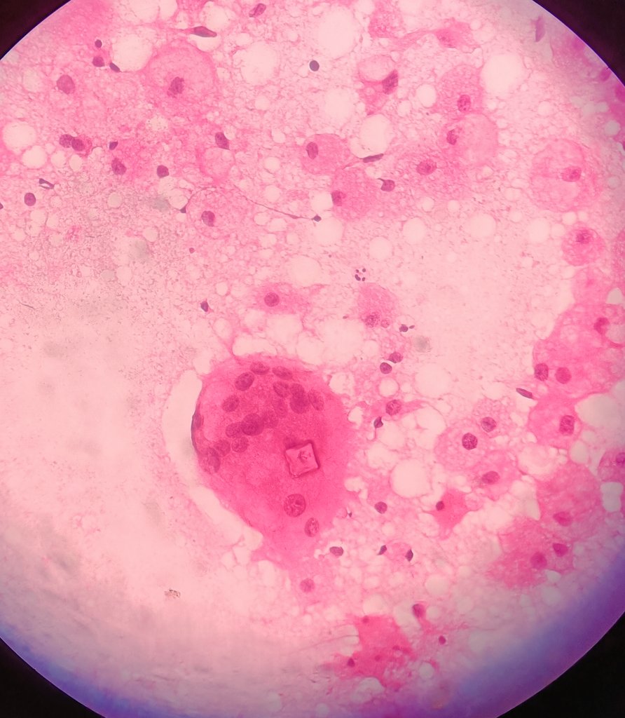 34 yr old female with breast pump. Aspirated dirty white viscous material. 
#Whoareyou? @VijayPatho @archibhat3 @RamyaPathology @ParasiteGal